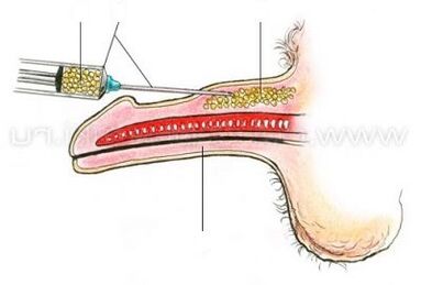 تكبير القضيب بالحقن